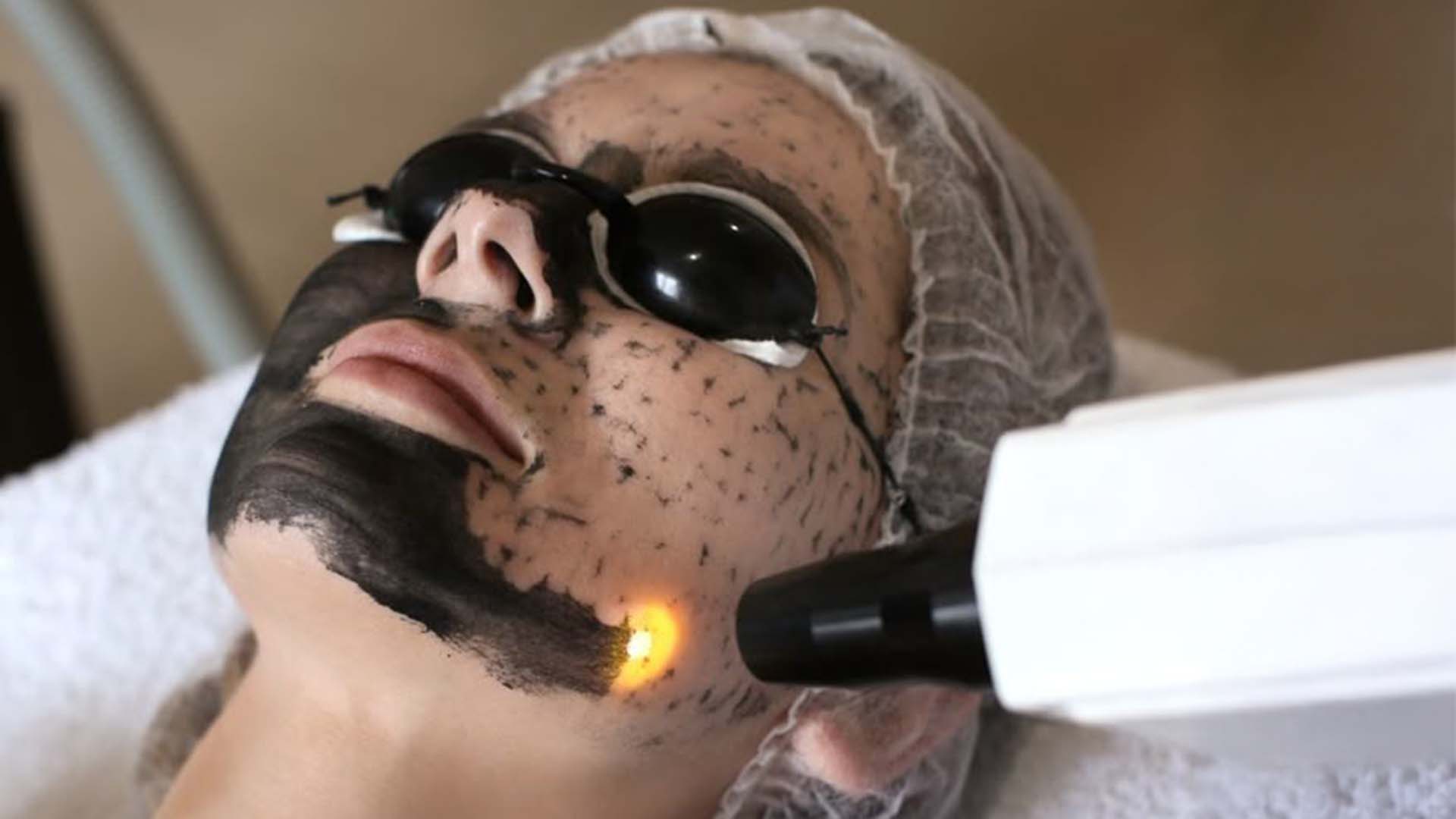 Carbon Peeling München