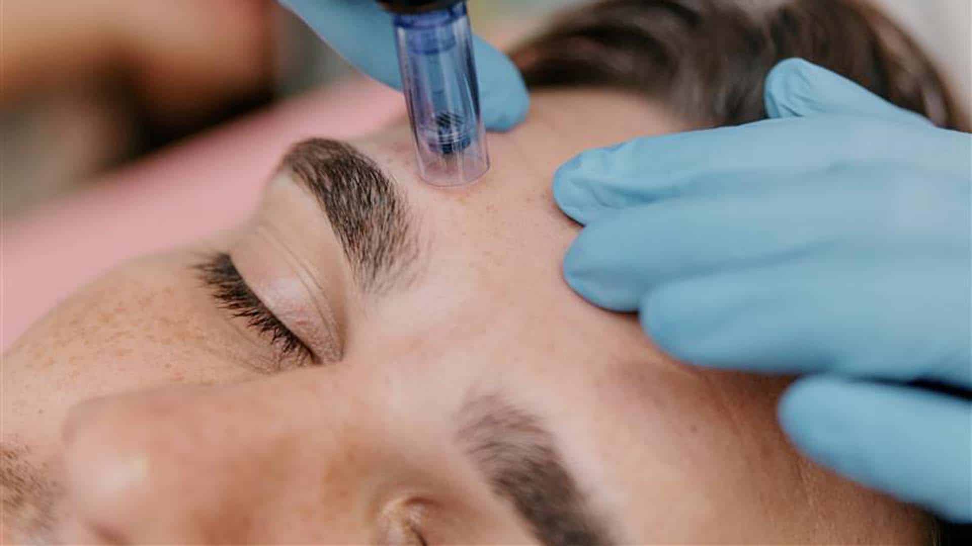 Microneedling Ingolstadt