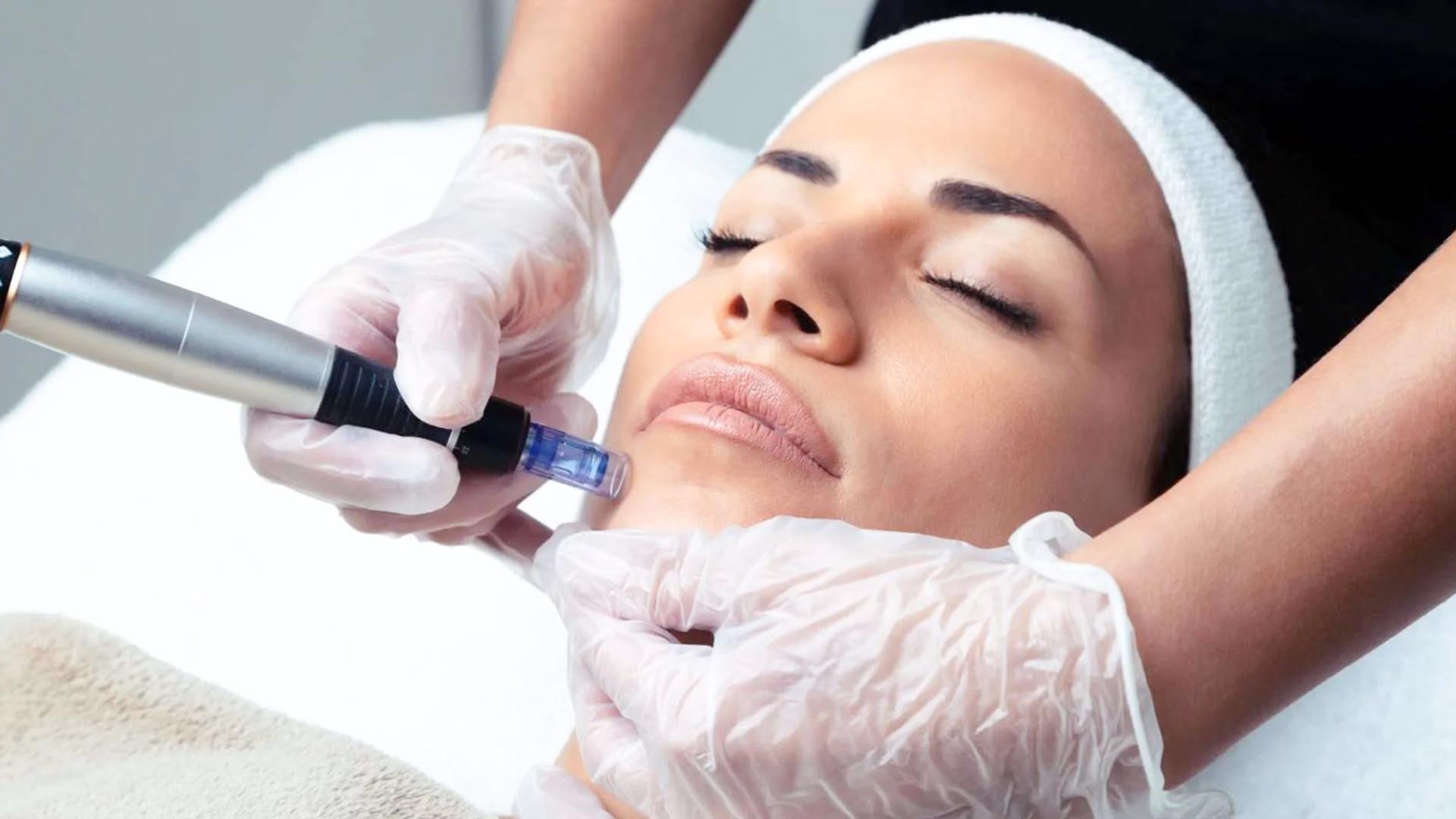 Microneedling München