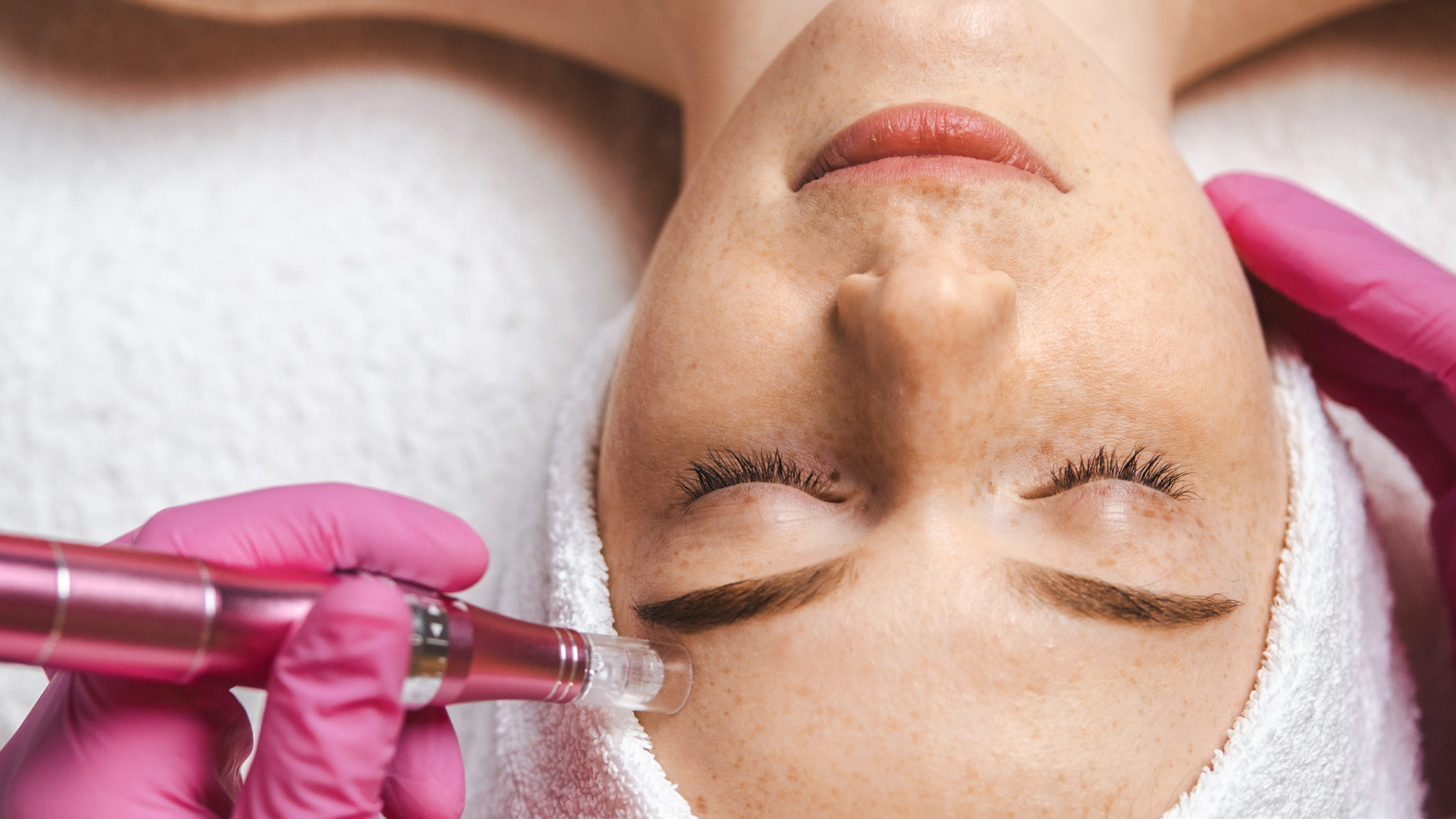 Microneedling Stuttgart